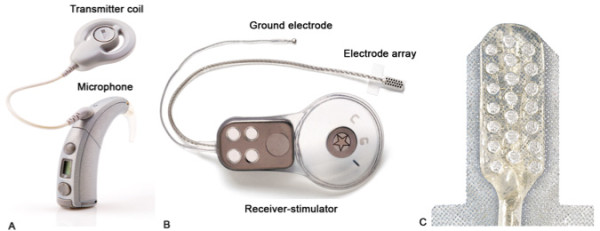 auditory brainstem implant